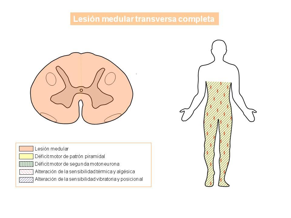 Fisioterapia Respiratoria En Pacientes Con Tetraplejia Por Lesi N Medular